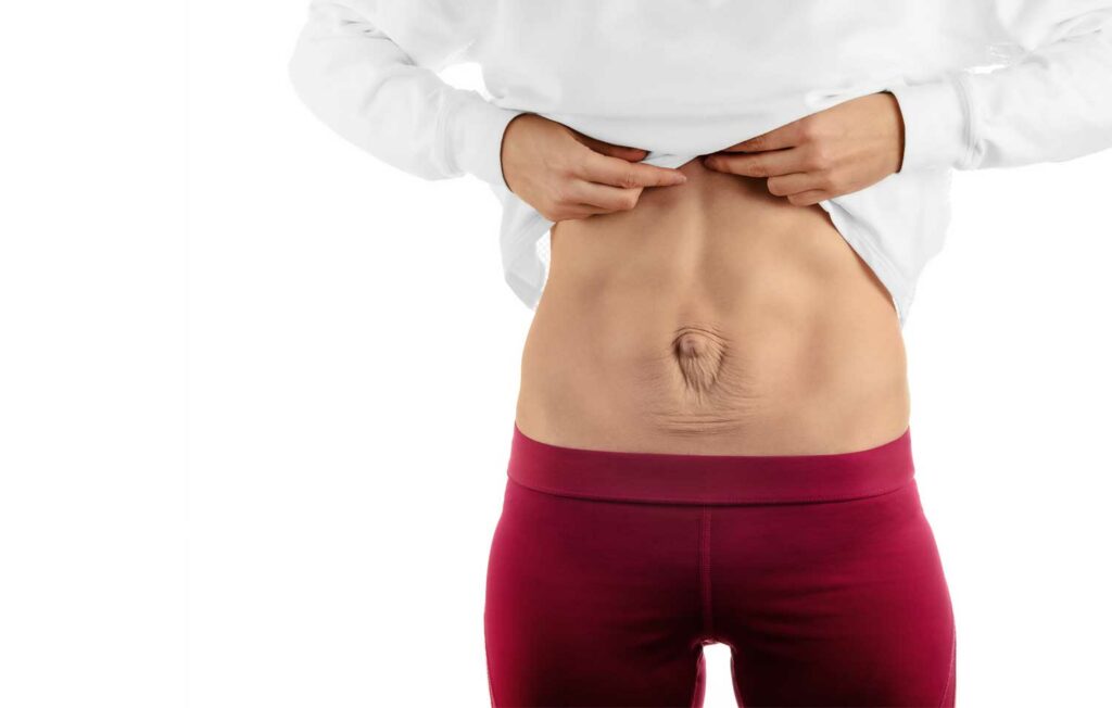 rektusdiastas med bukplastik