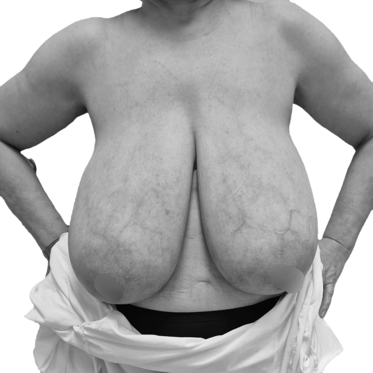 Bröstförminskning – före
