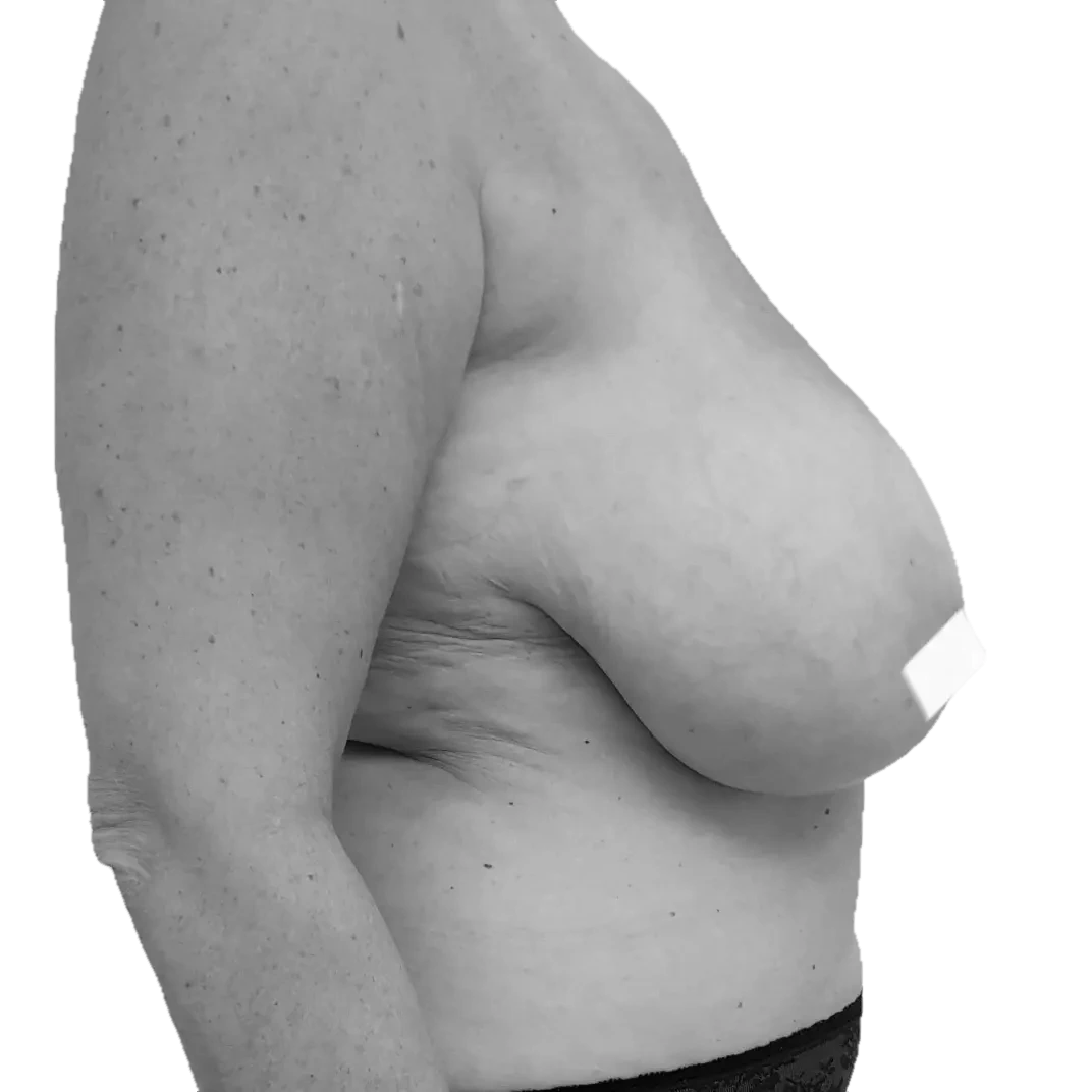 Bröstförminskning – före