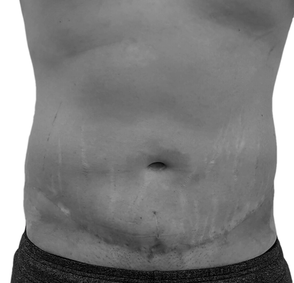 Bukplastik – efter