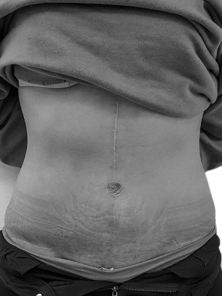 Bukplastik – efter