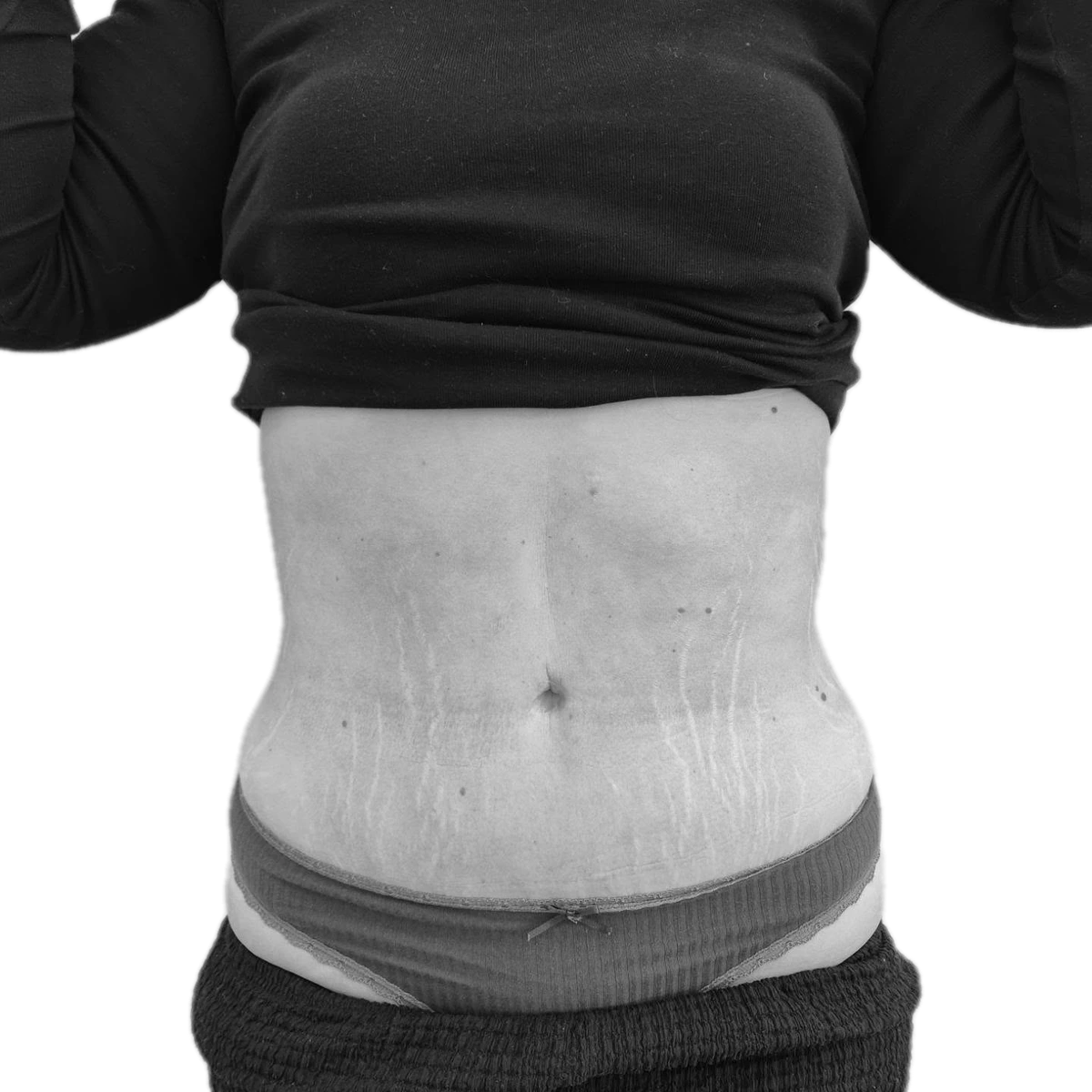 Bukplastik – efter