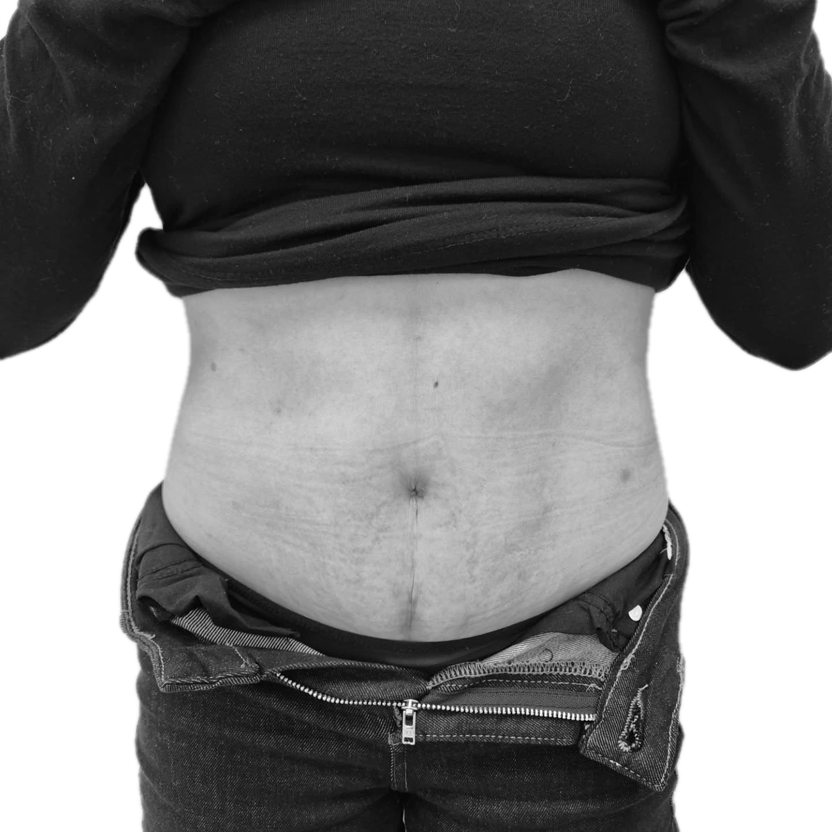 Bukplastik – efter