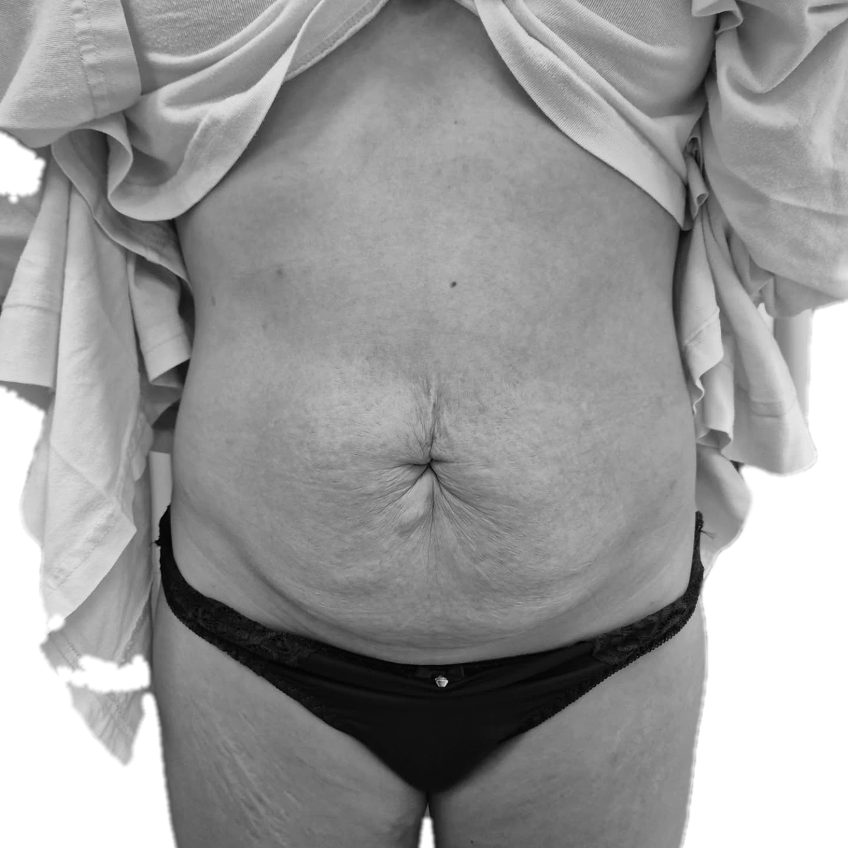 Bukplastik – före