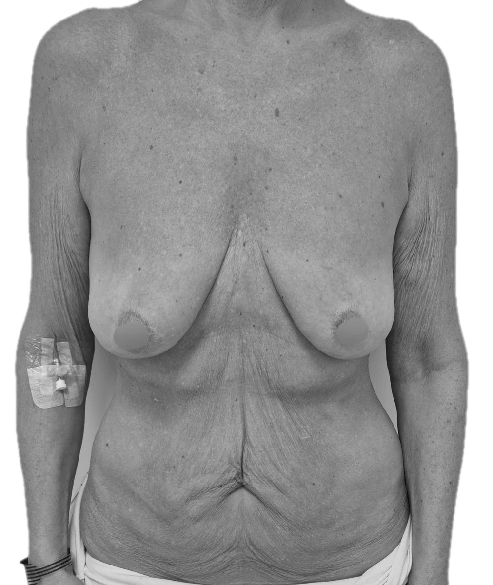 Bukplastik – före