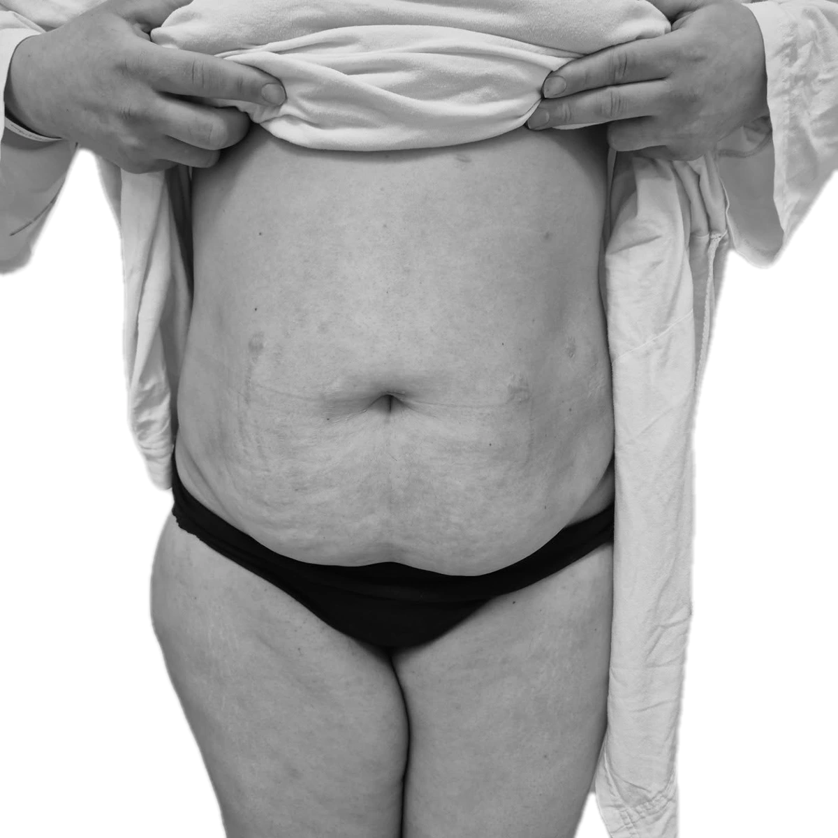 Bukplastik – före