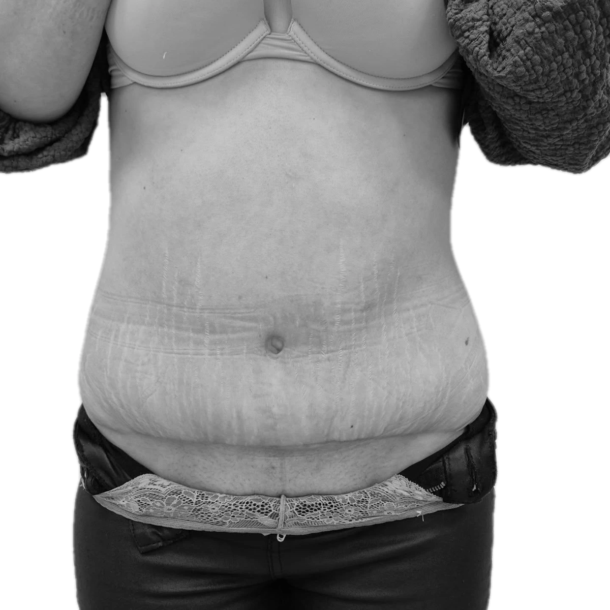 Bukplastik – efter
