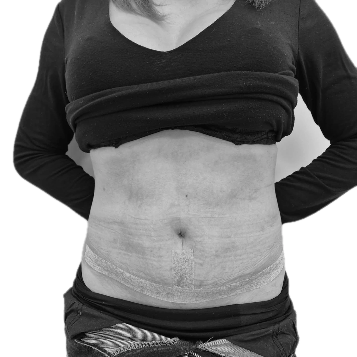 Bukplastik – efter
