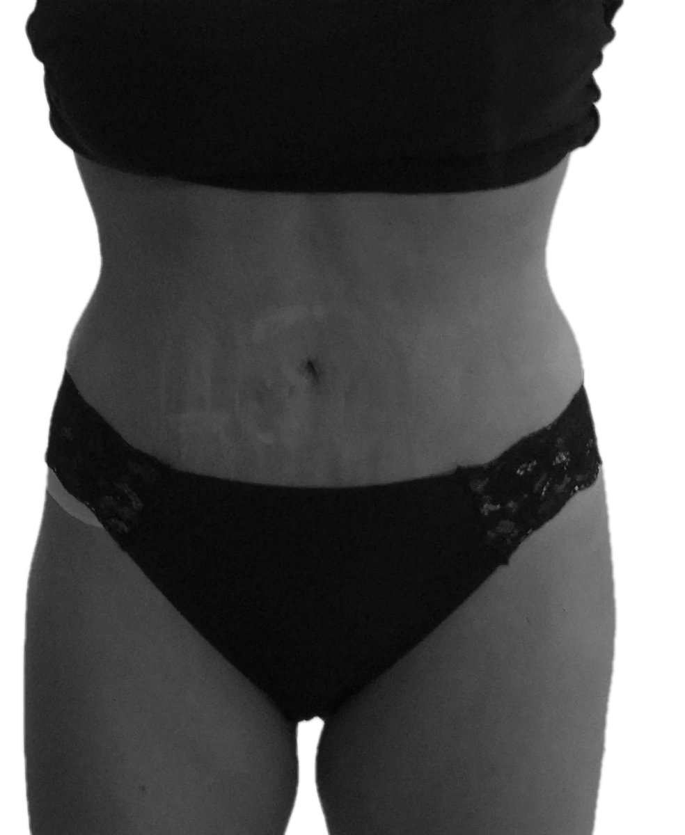 Bukplastik – efter