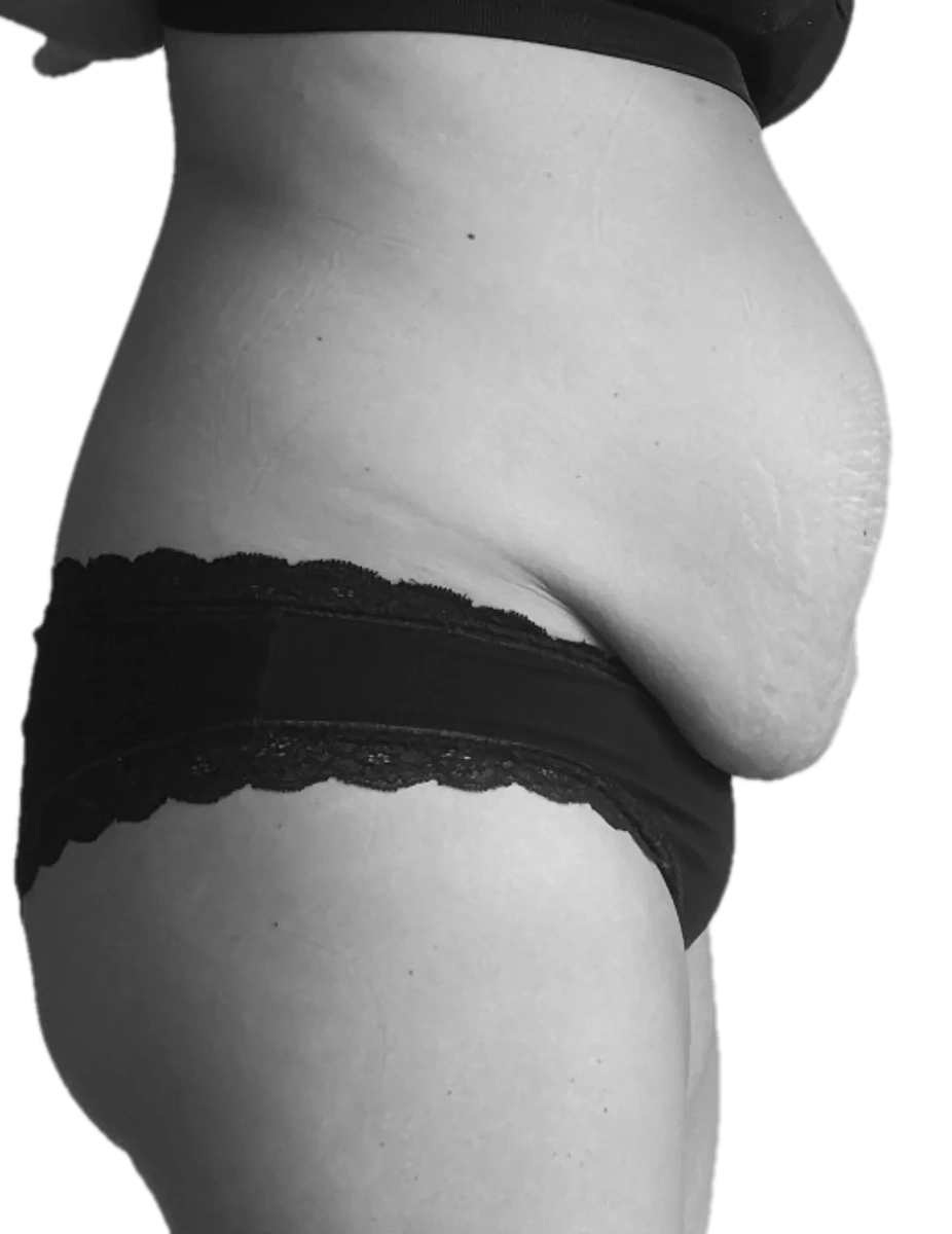Bukplastik – före