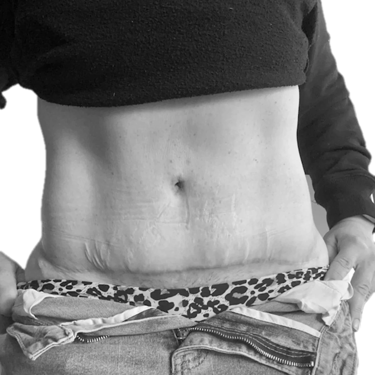 Bukplastik – efter