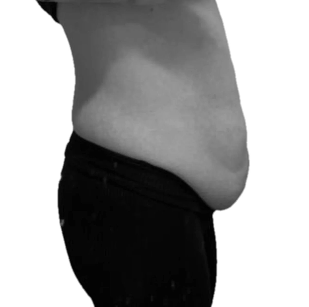 Bukplastik – före