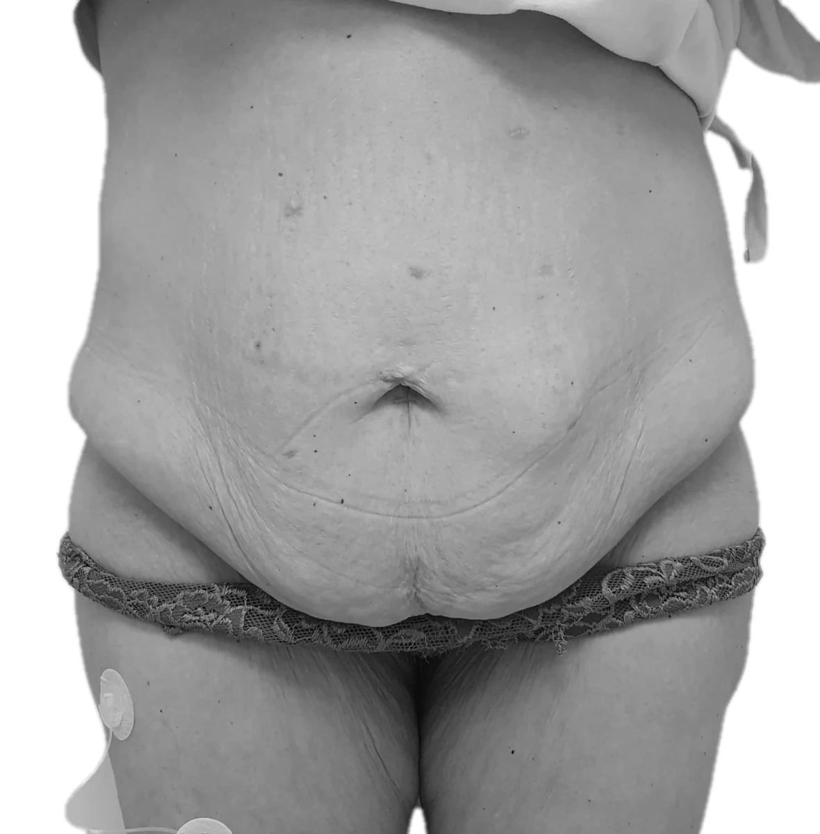 Bukplastik – före