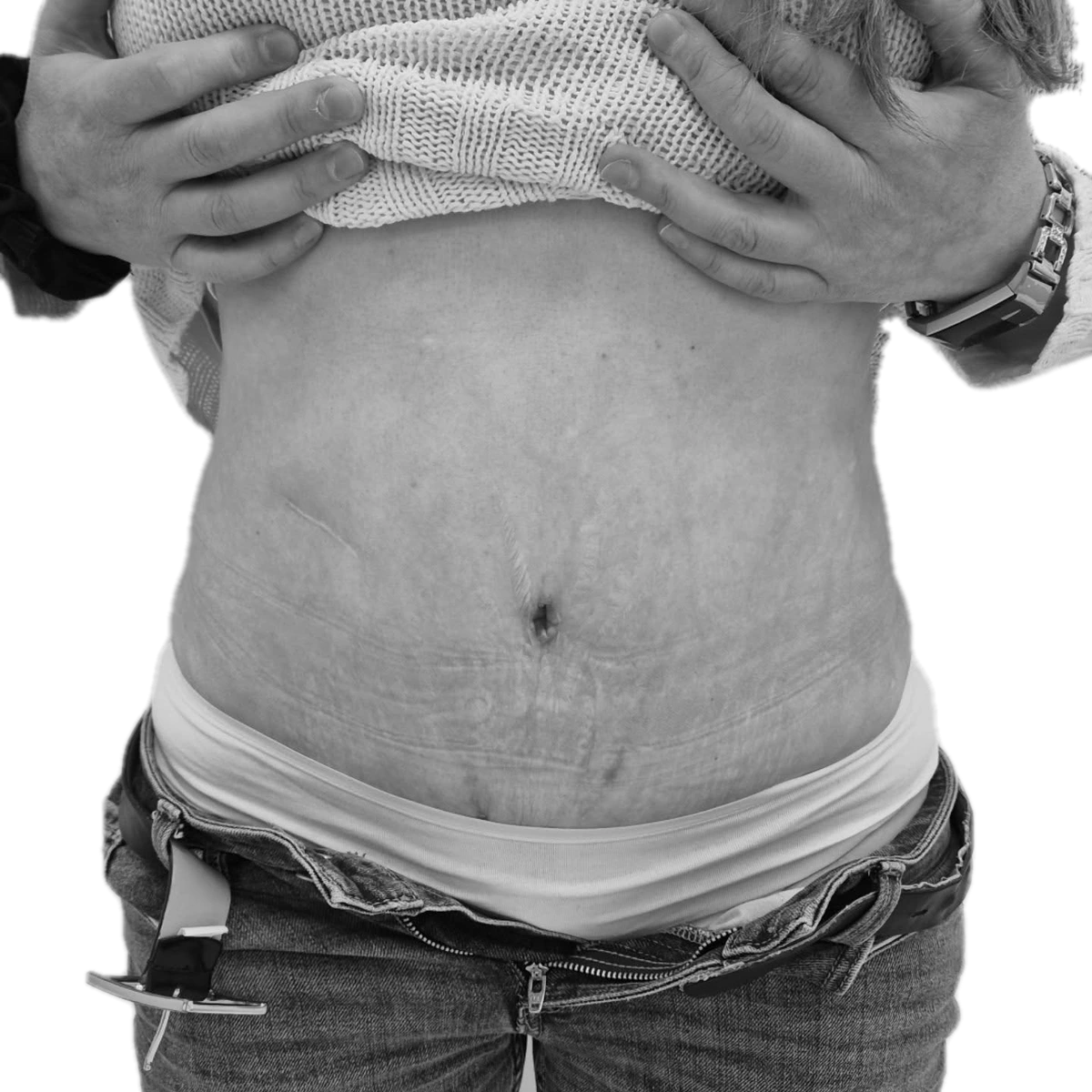 Bukplastik – efter