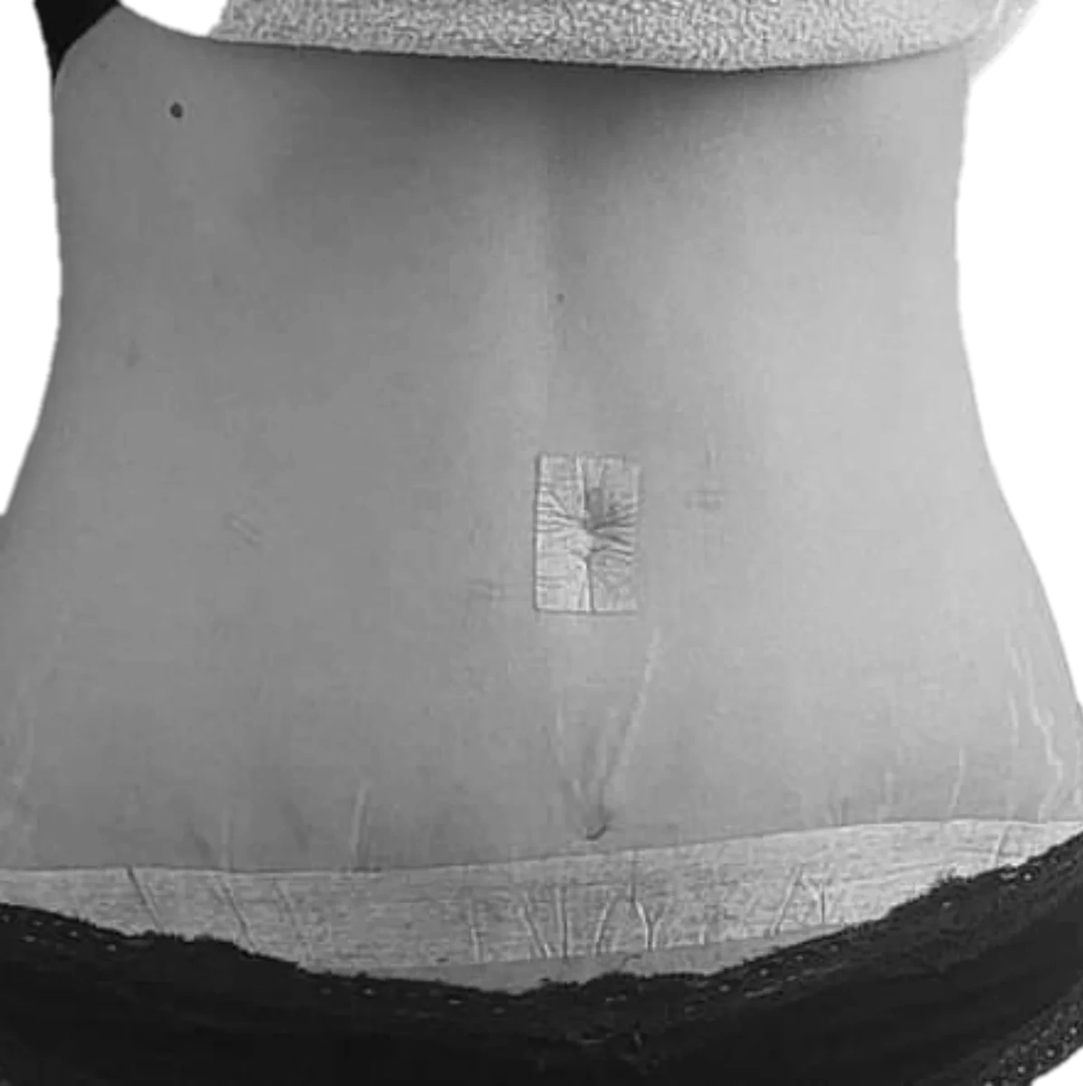 Bukplastik – efter