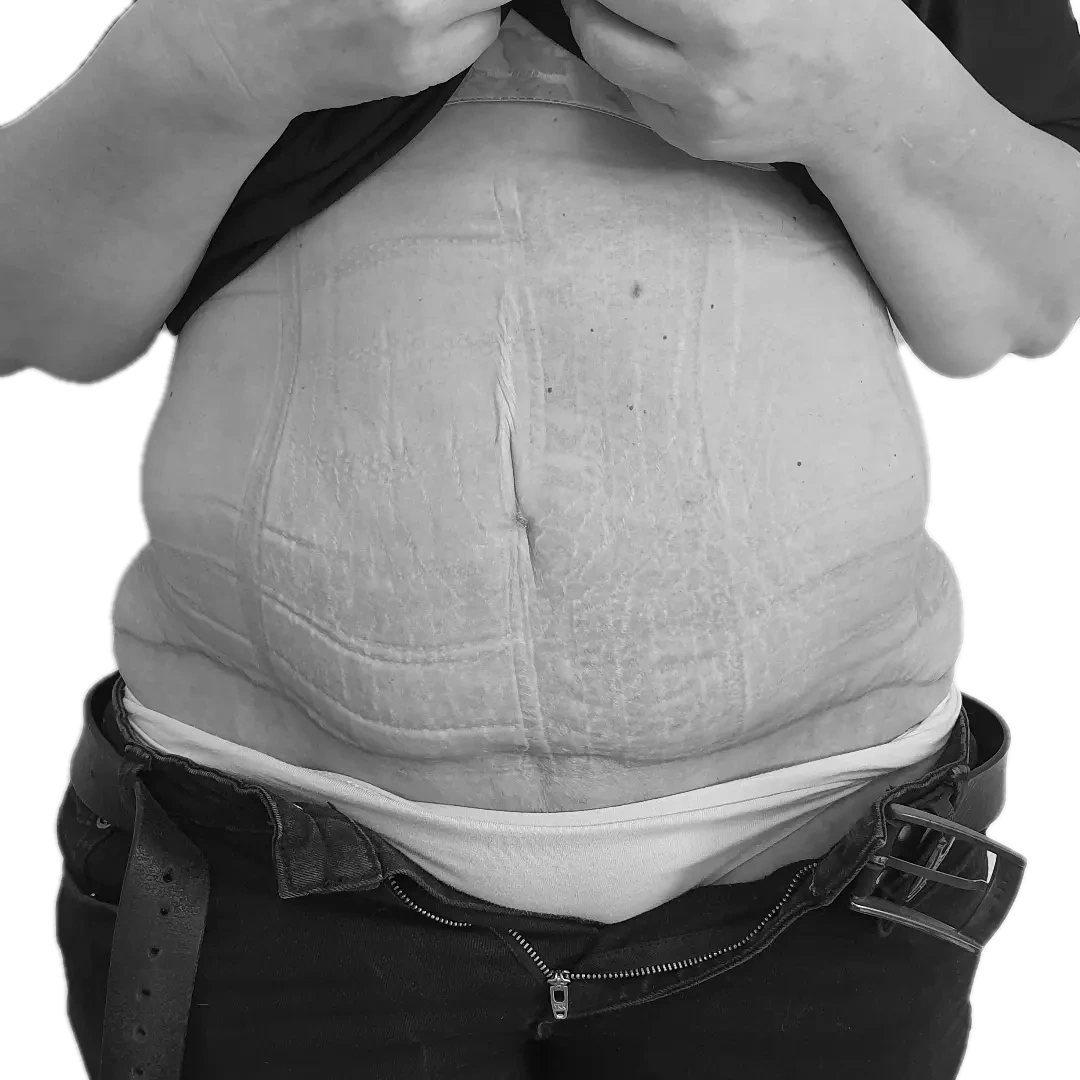 Bukplastik – efter