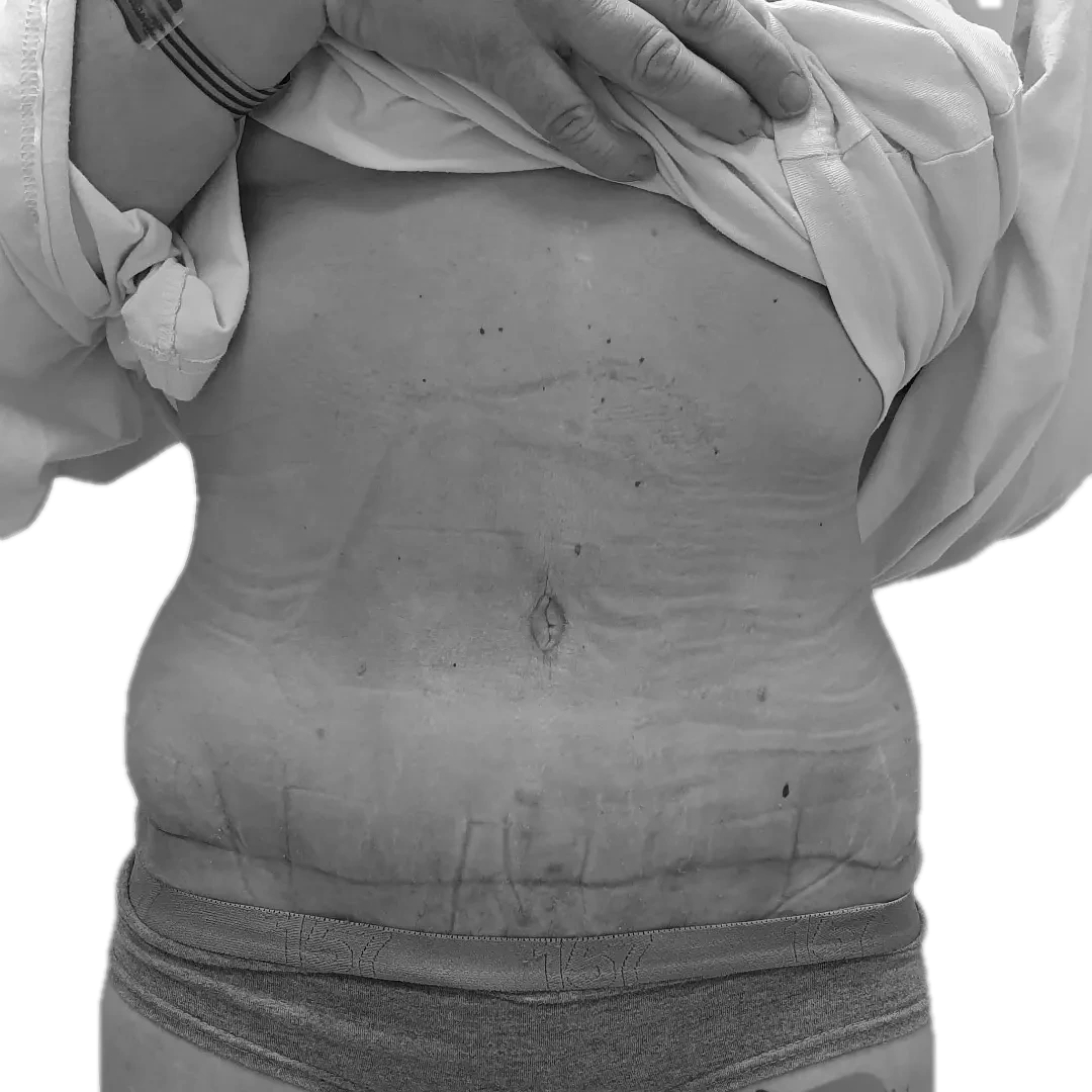 Bukplastik – efter