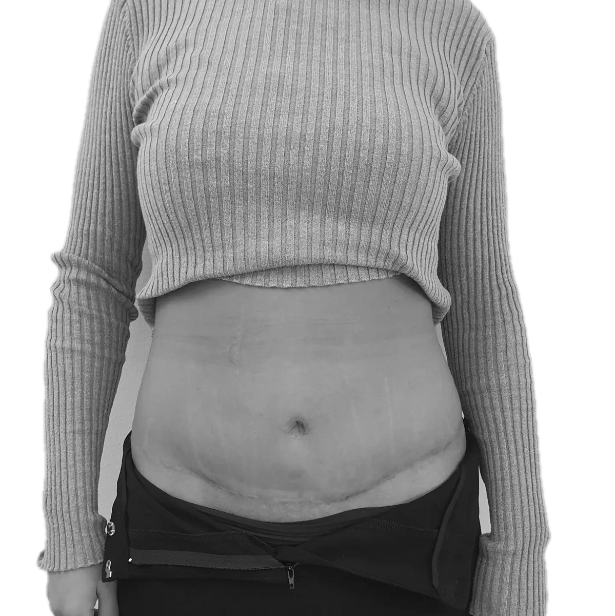 Bukplastik – efter