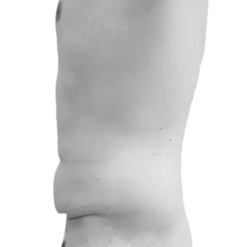 Bukplastik – före