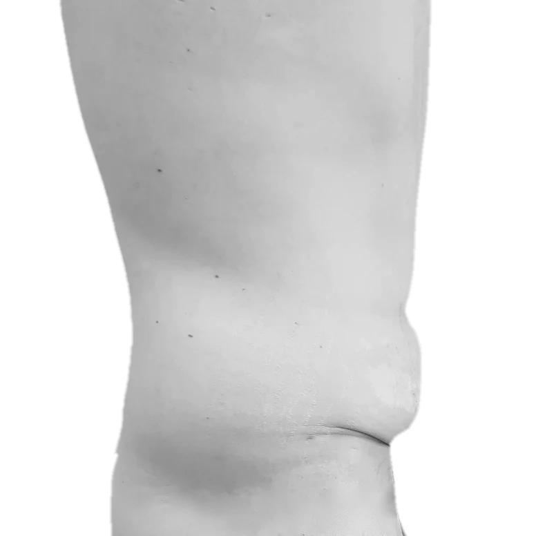 Bukplastik – före