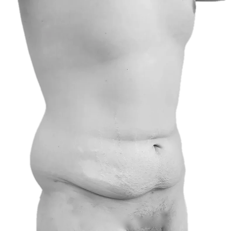 Bukplastik – före