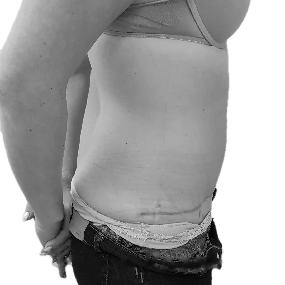 Bukplastik – efter
