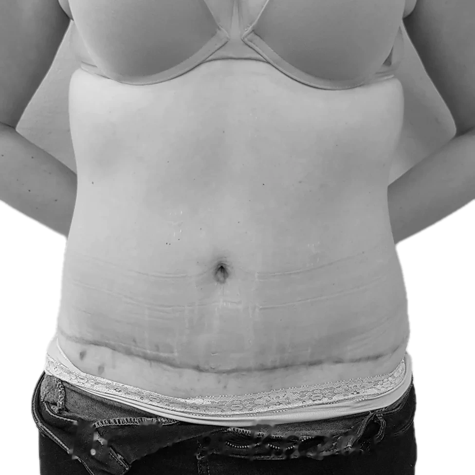 Bukplastik – efter