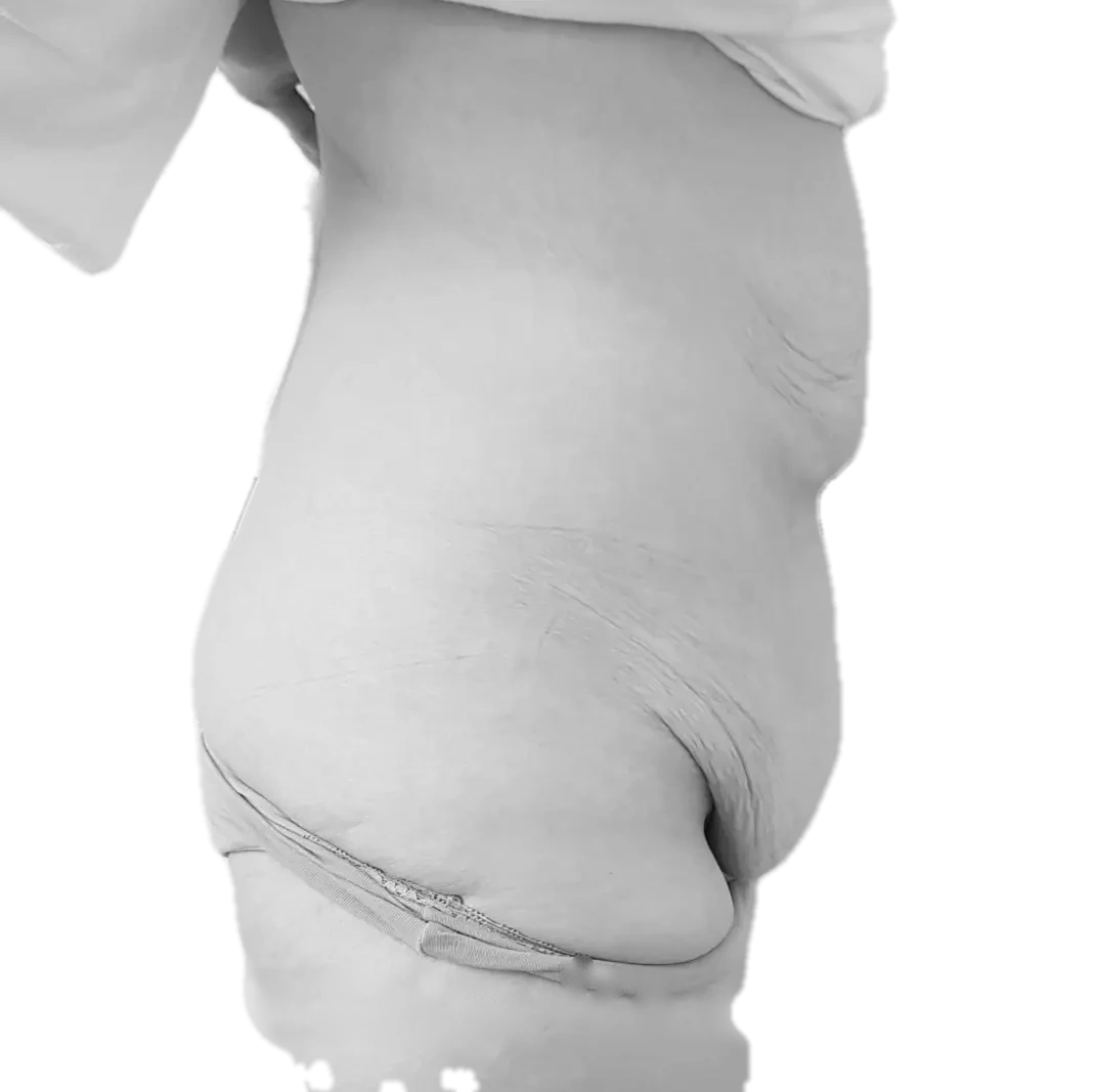 Bukplastik – före