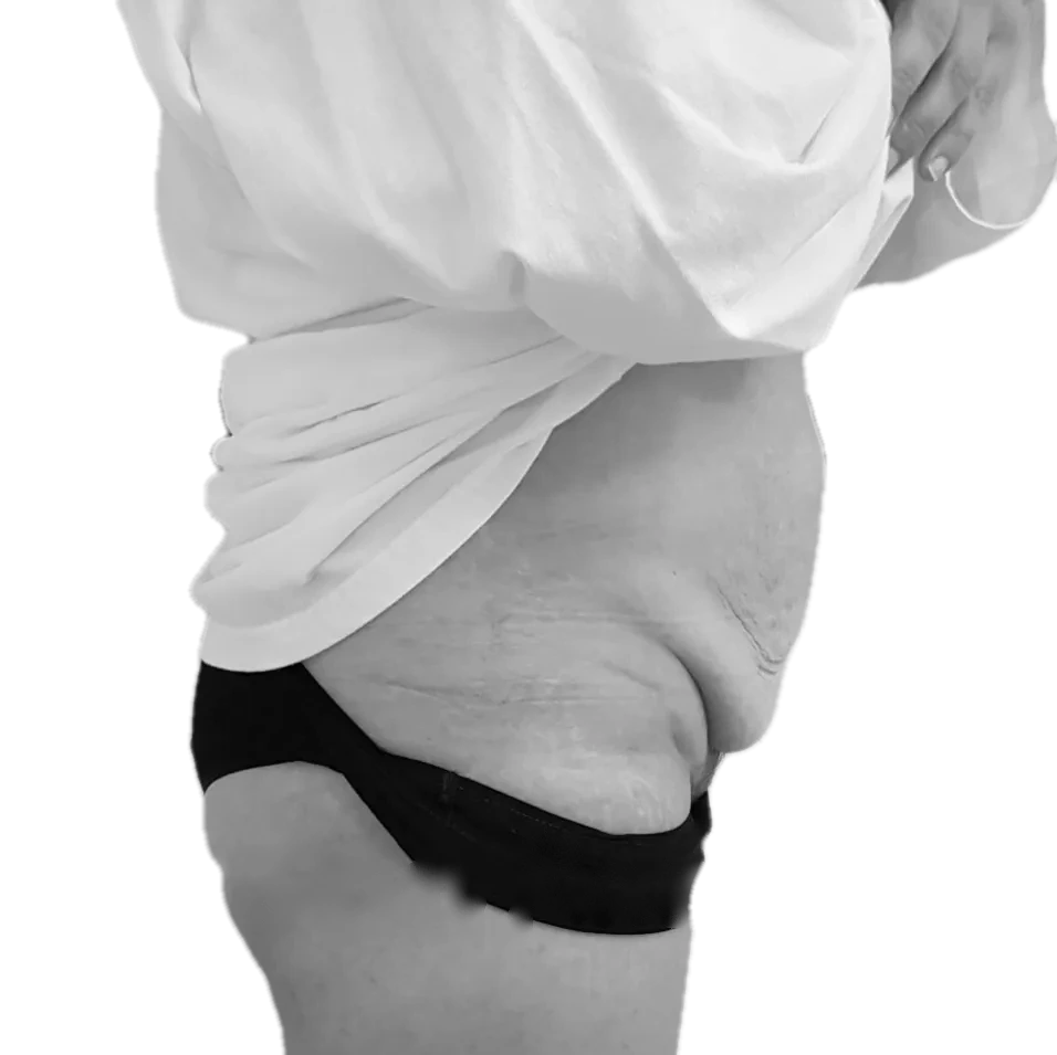 Bukplastik – före