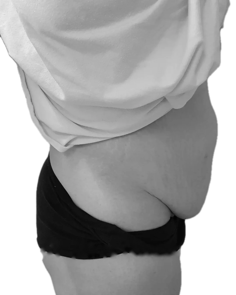 Bukplastik – före
