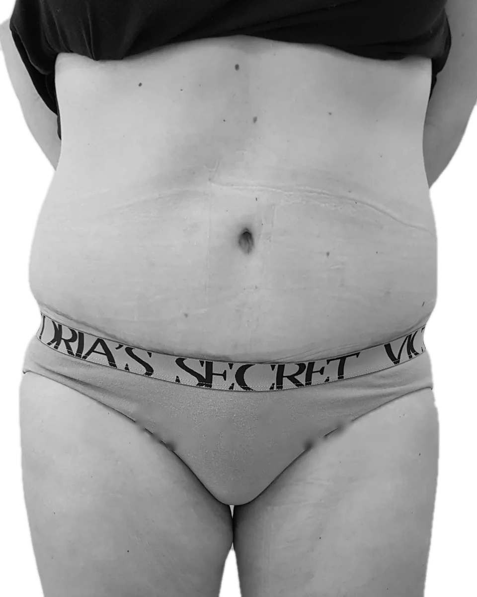 Bukplastik – efter