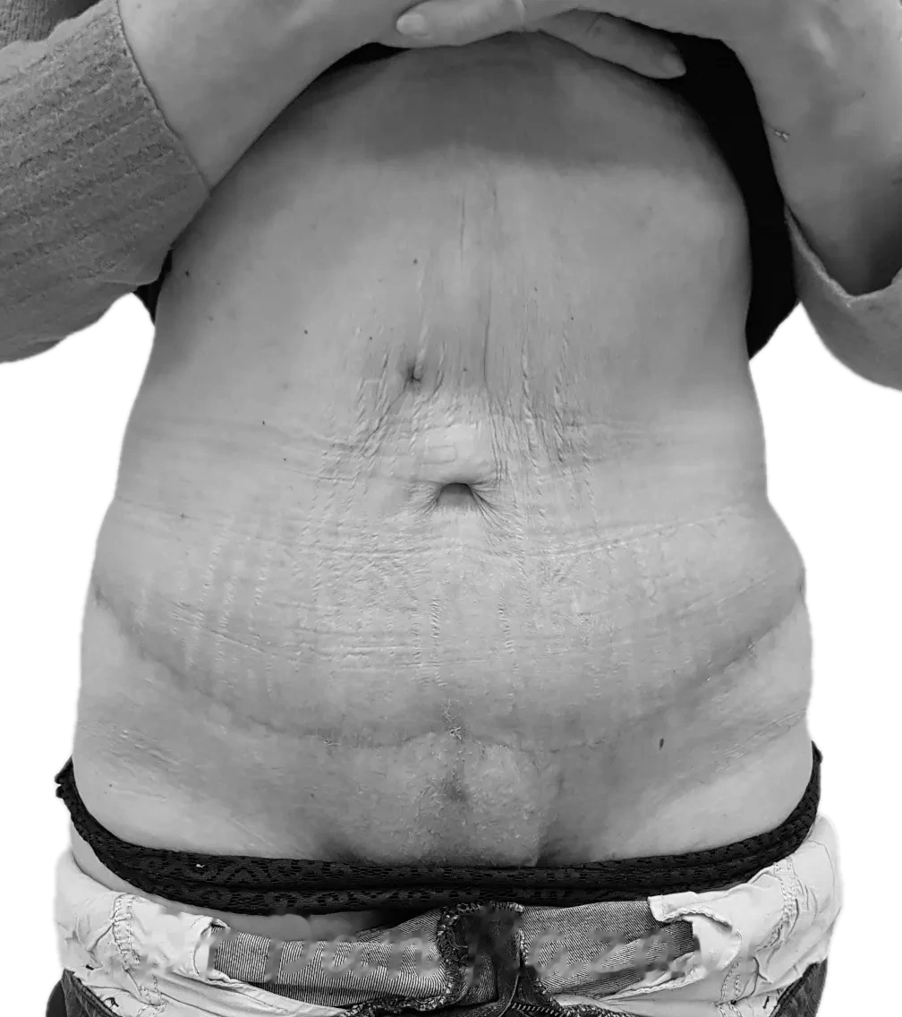 Bukplastik – efter