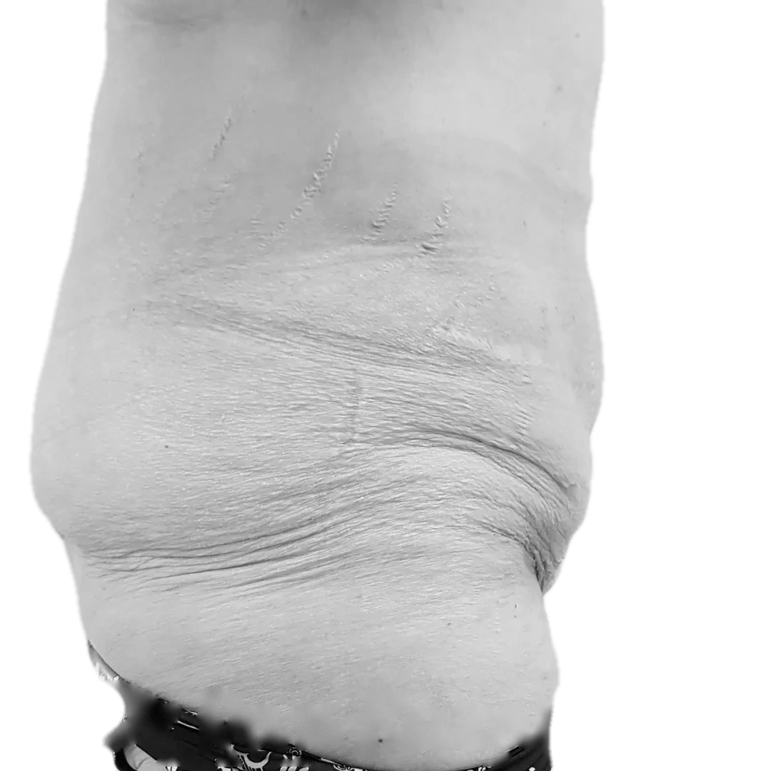 Bukplastik – före