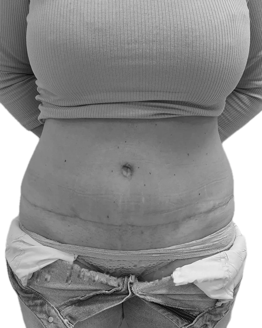 Bukplastik – efter