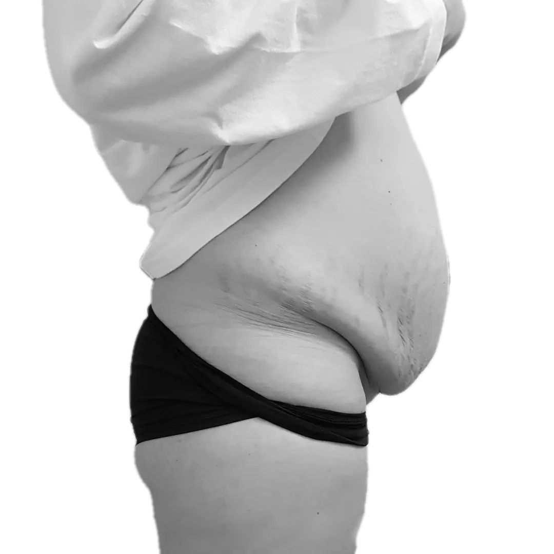 Bukplastik – före