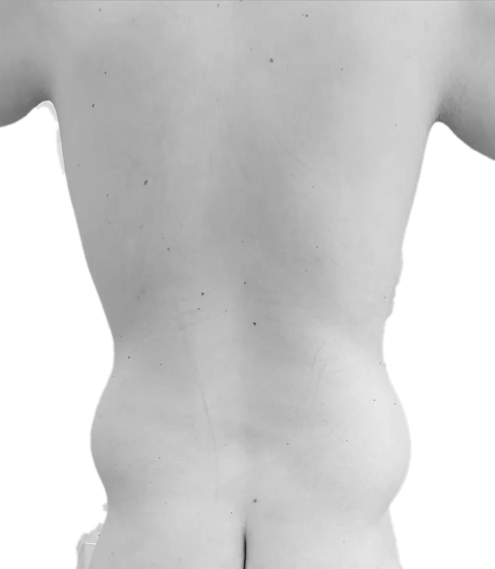 Bukplastik – före