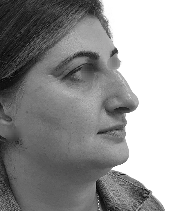 Näsplastik – före