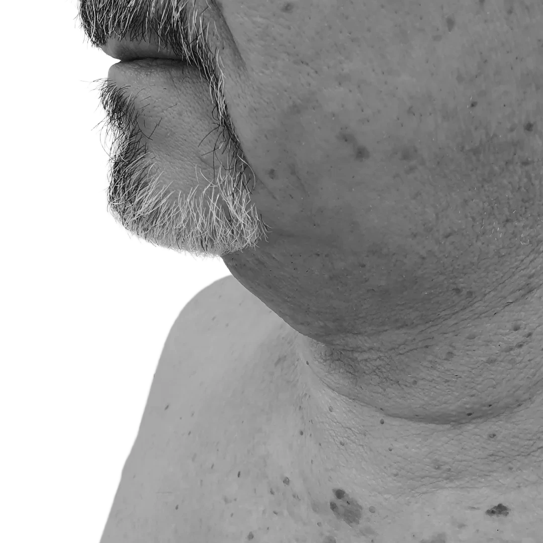 Halslyft – före