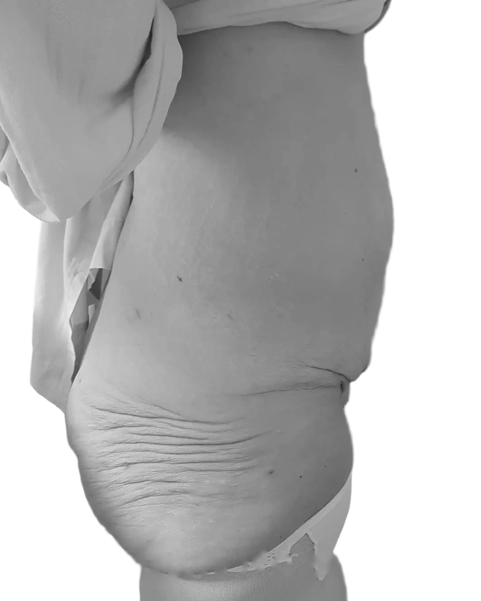 Bukplastik – före