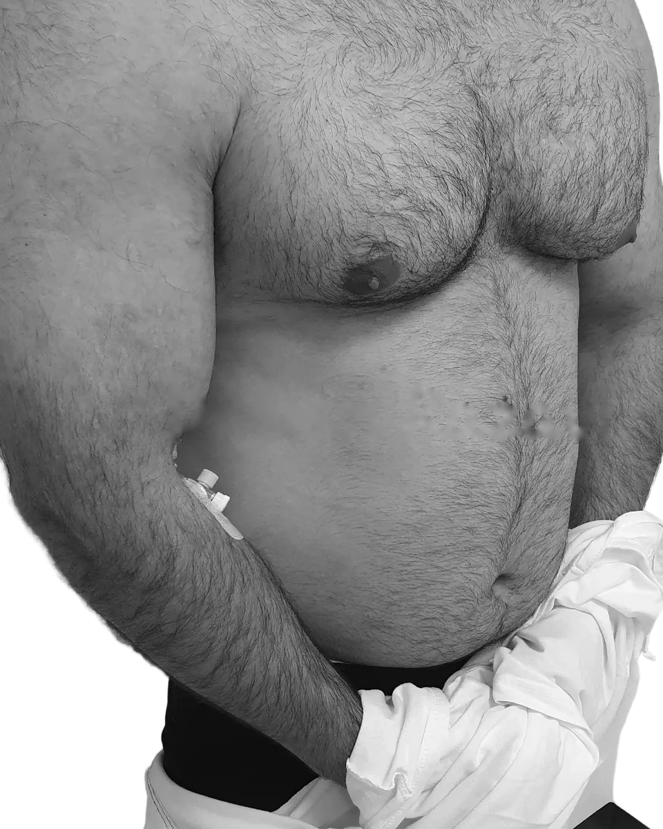Gynekomasti – före