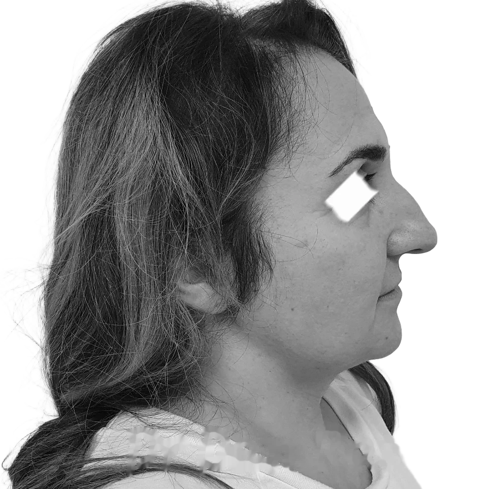 Näsplastik – före