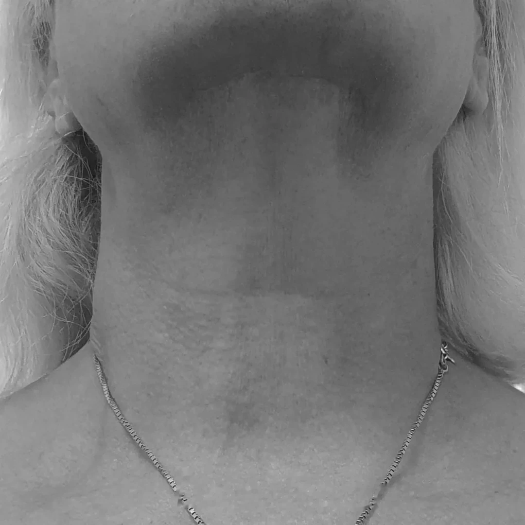 Halslyft – efter