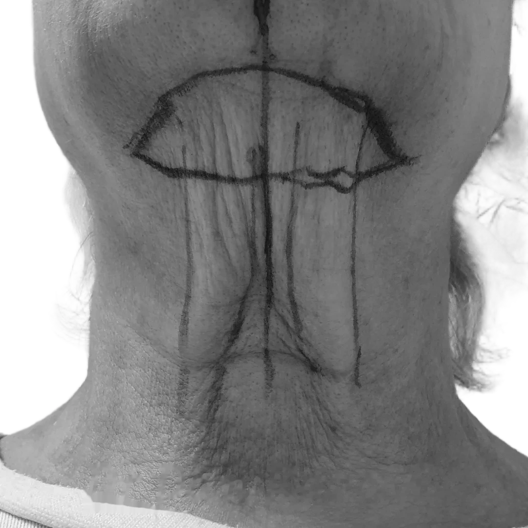 Halslyft – före