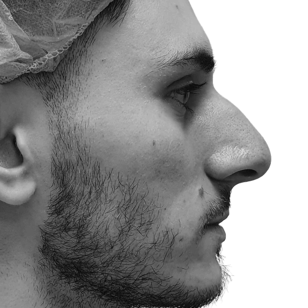 Näsplastik – före