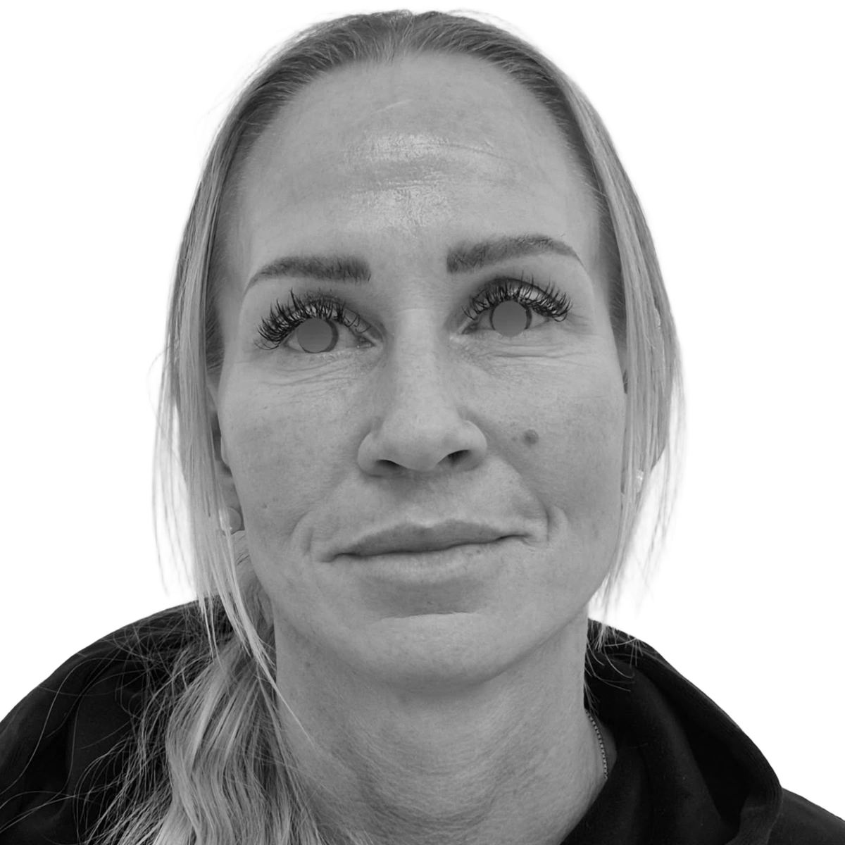 Ansiktslyft och Läpplyft – efter