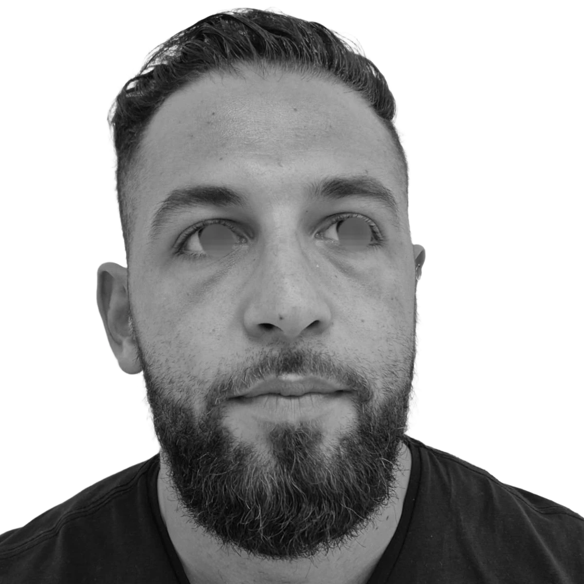 Näsplastik – efter