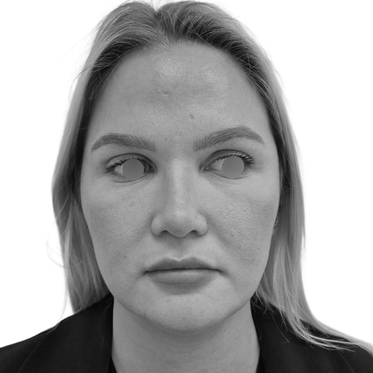 Näsplastik – efter