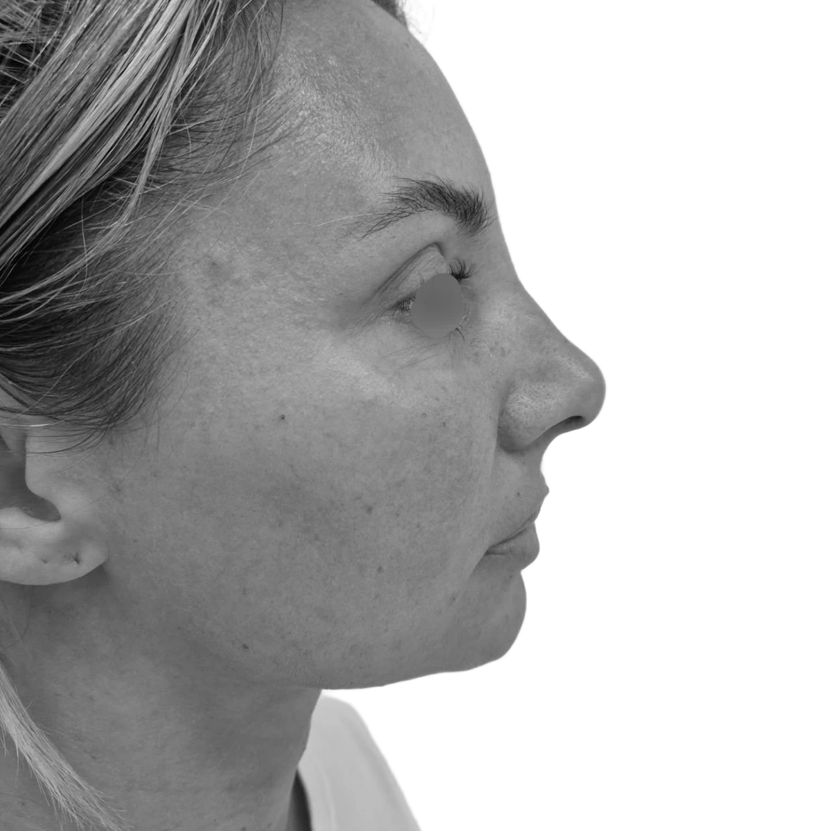 Näsplastik – efter