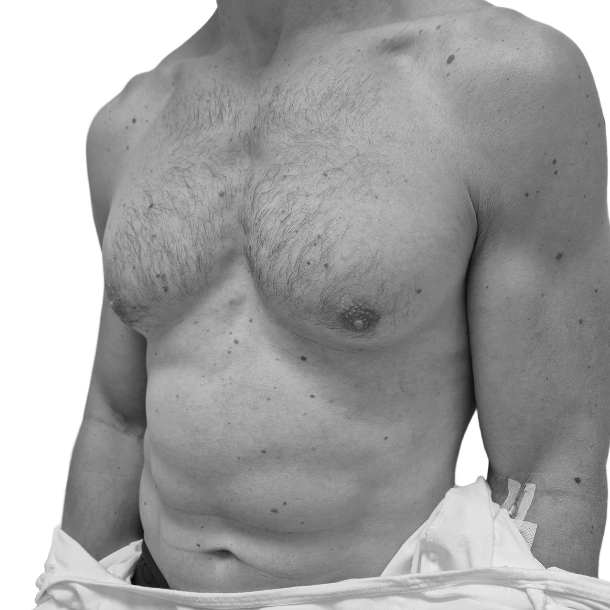 Gynekomasti – före