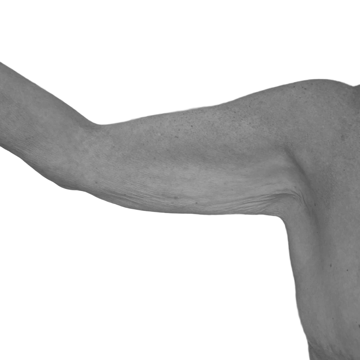 Överarmsplastik – före